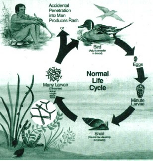 Swimmer's Itch Caused by Larva