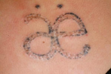 Tattoo Removal After 2 laser treatments