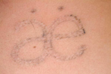 Tattoo removal after 4 laser treatments