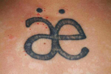 Laser Tattoo Removal - before treatment