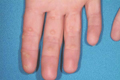 Warts on a hand