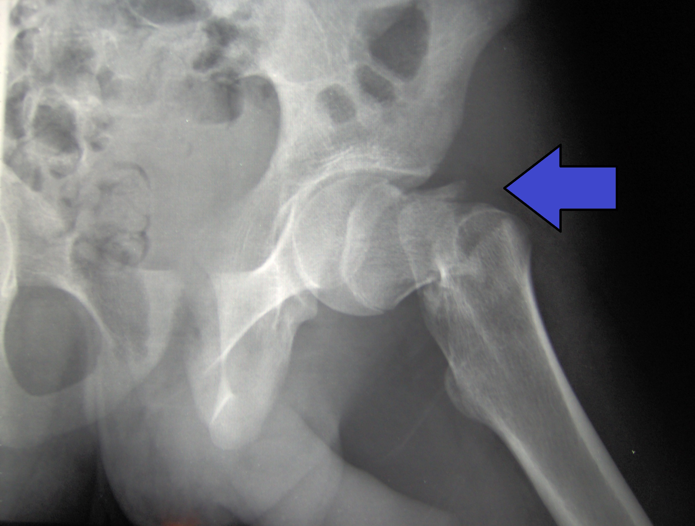 Hip Fracture Surgical Repair