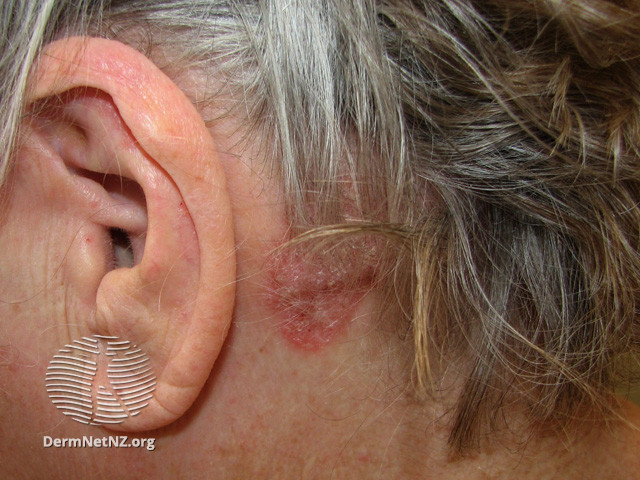 Psoriasis Of The Scalp Patient Education